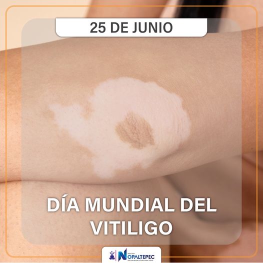 1687734526 El vitiligo es una enfermedad cutanea cronica y no